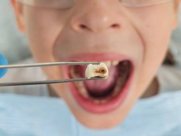 Best Emergency Tooth Extraction in New Lexington, OH