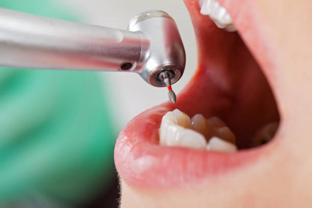 Best Emergency Root Canal Treatment in New Lexington, OH